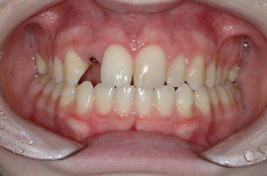 Esthetic Crown Lengthening case study
