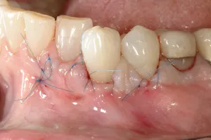 Allograft case study