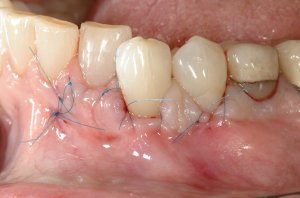 Allograft case study