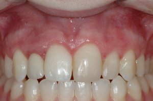 Esthetic Crown Lengthening case study