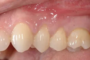 Allograft case study