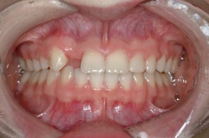 Dental Implants case study