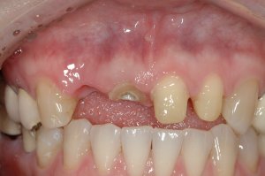 Dental Implants case study