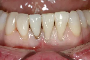 Connective Tissue Graft case study