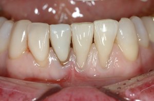 Connective Tissue Graft case study