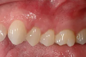 Allograft case study