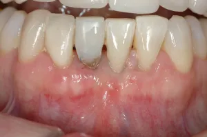 Connective Tissue Graft case study