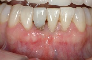 Connective Tissue Graft case study