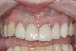 Dental Implants case study