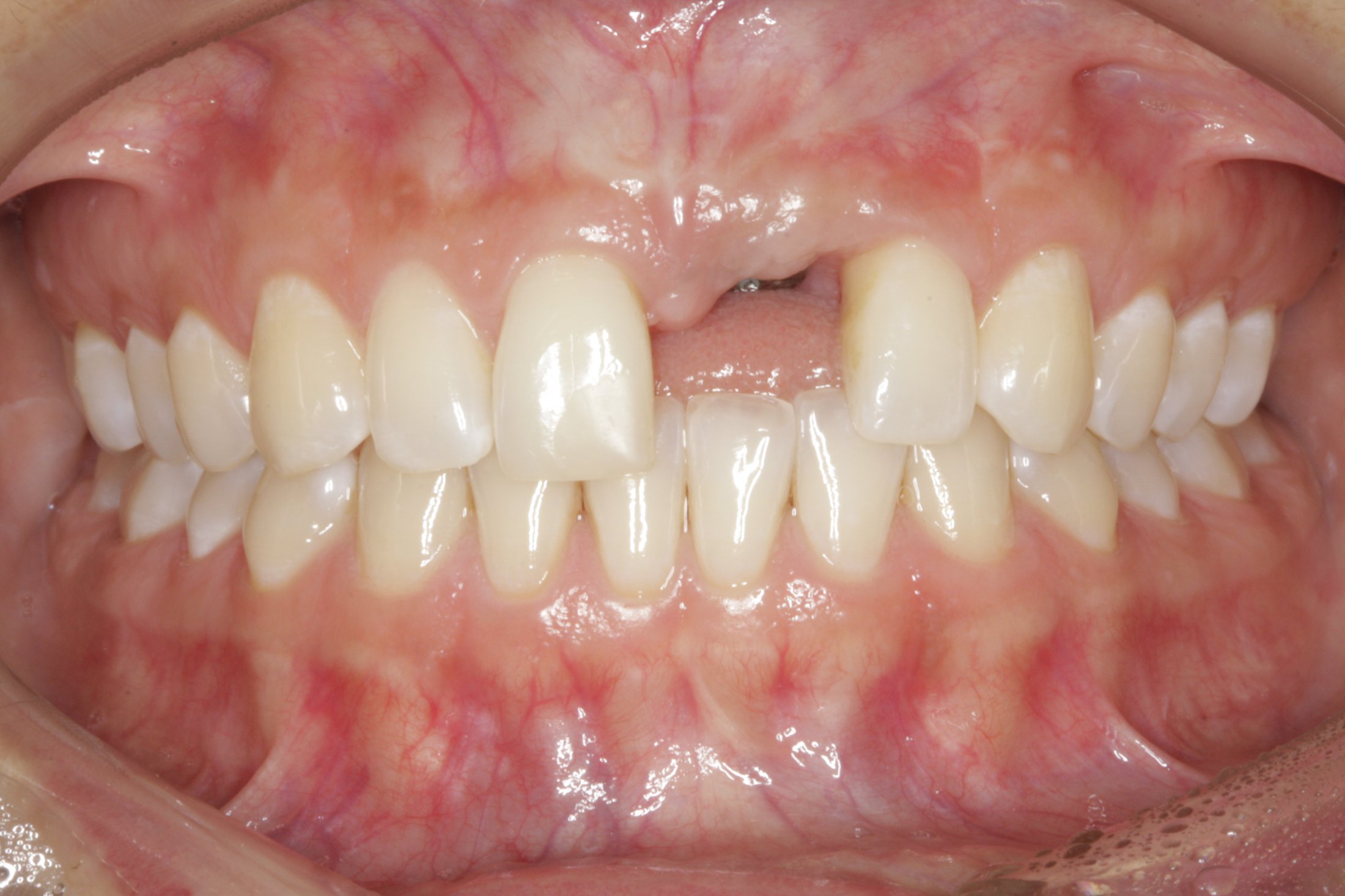 Dental Implants case study