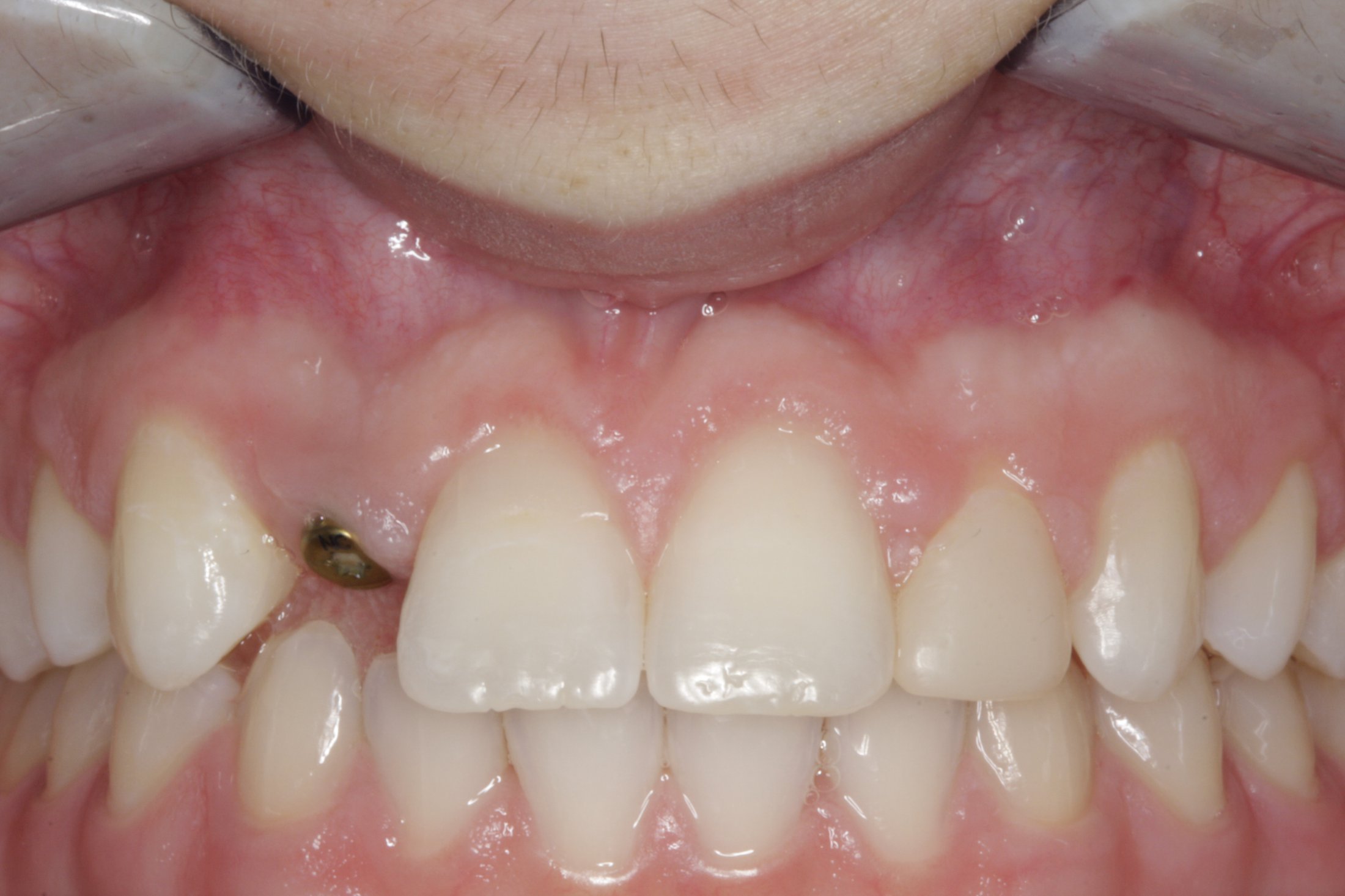 Dental Implants case study