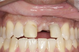 Dental Implants case study