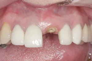 Dental Implants case study