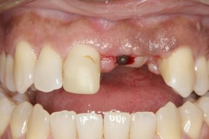 Dental Implants case study