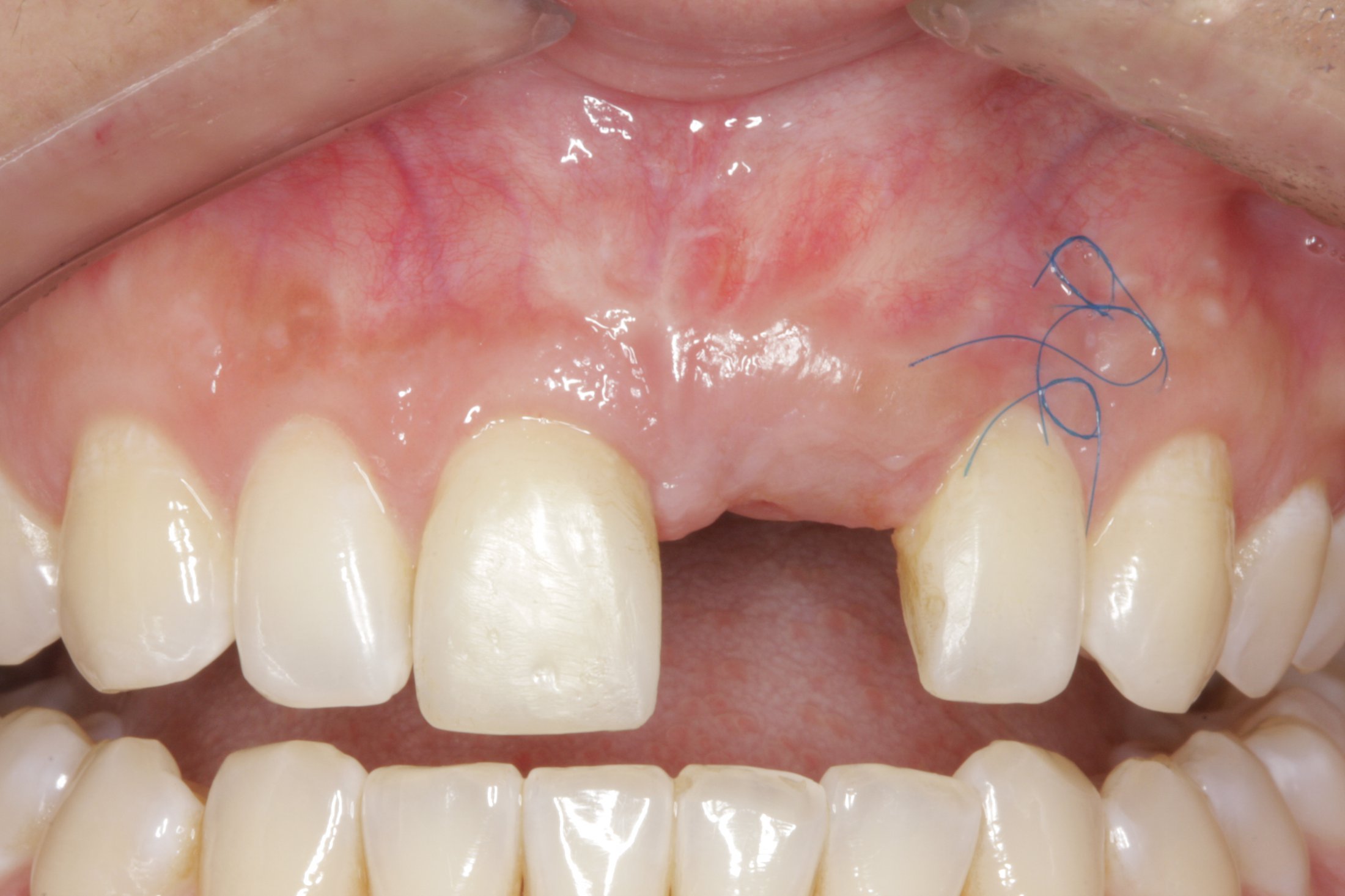 Dental Implants case study
