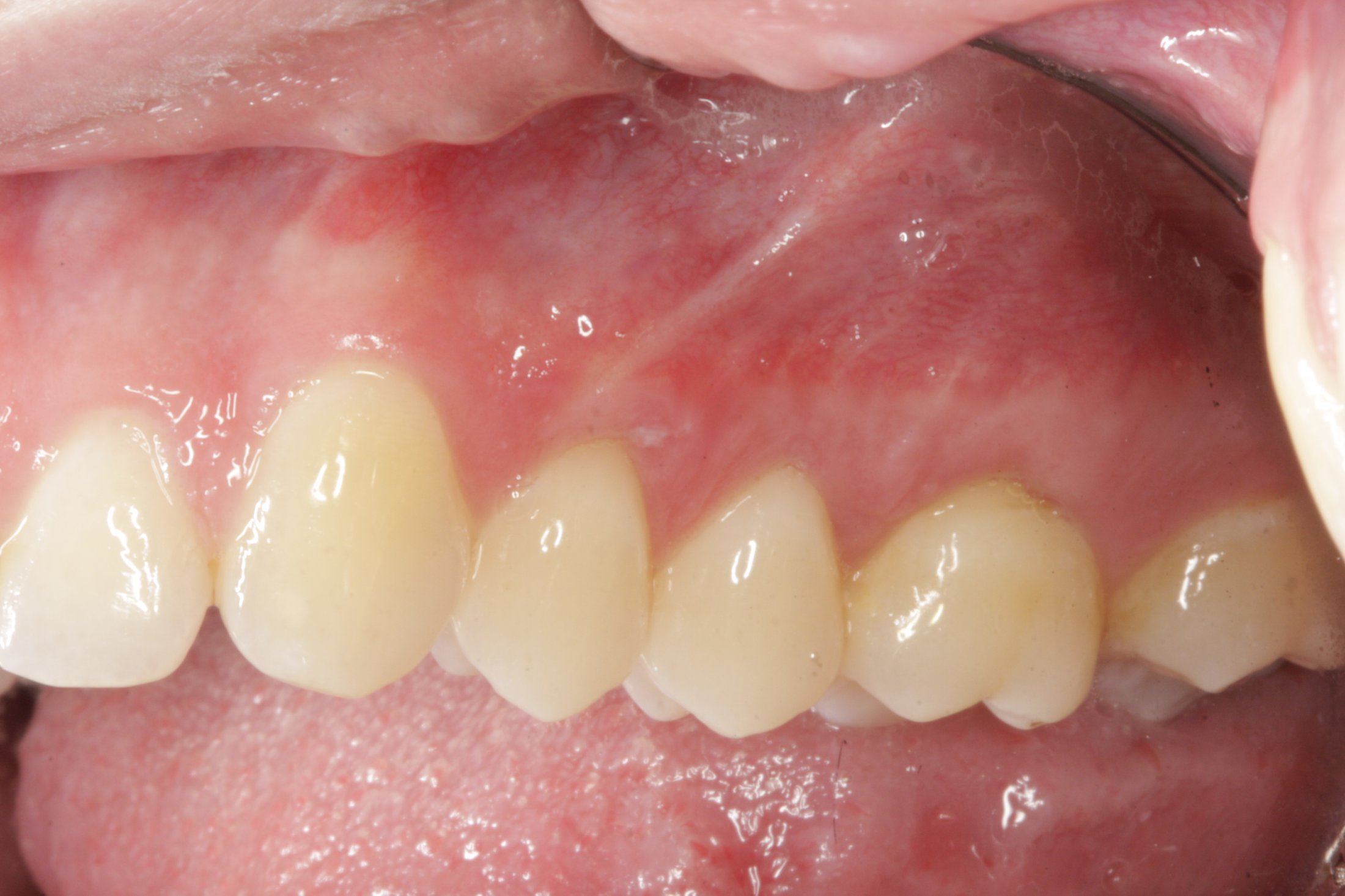 Allograft case study