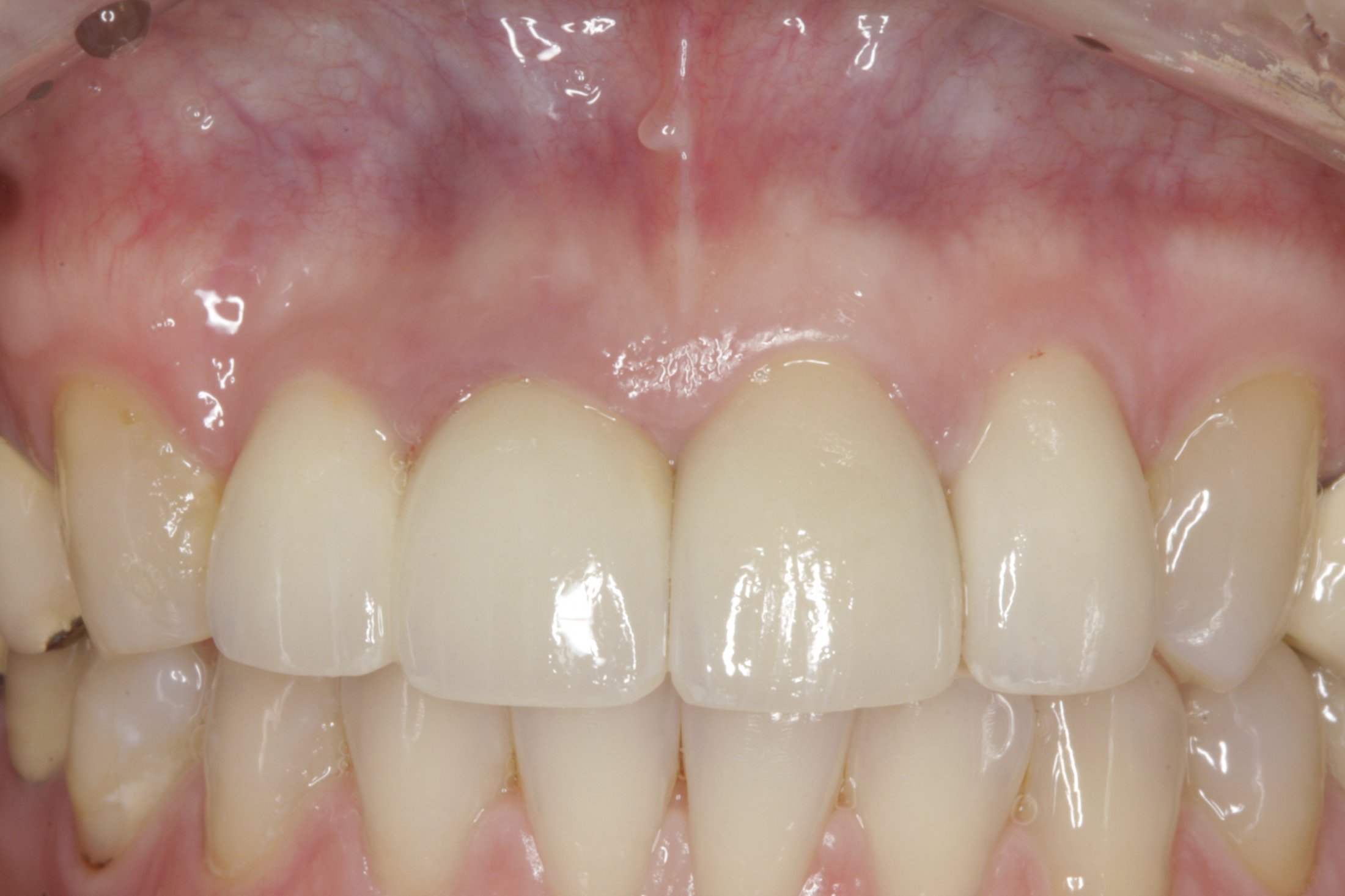 Dental Implants case study