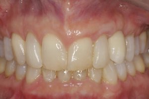 Dental Implants case study