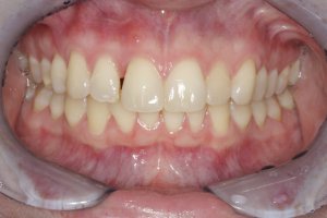 Dental Implants case study