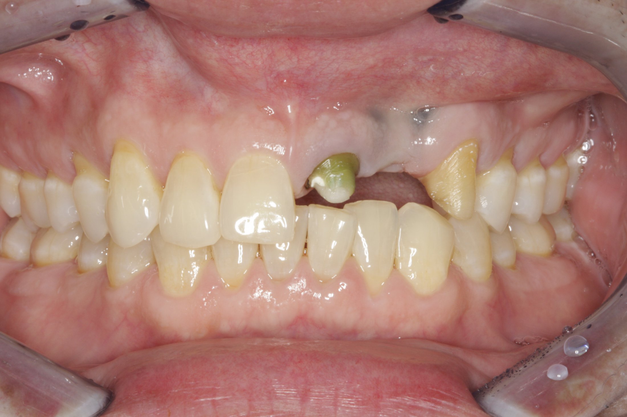 Dental Implants case study