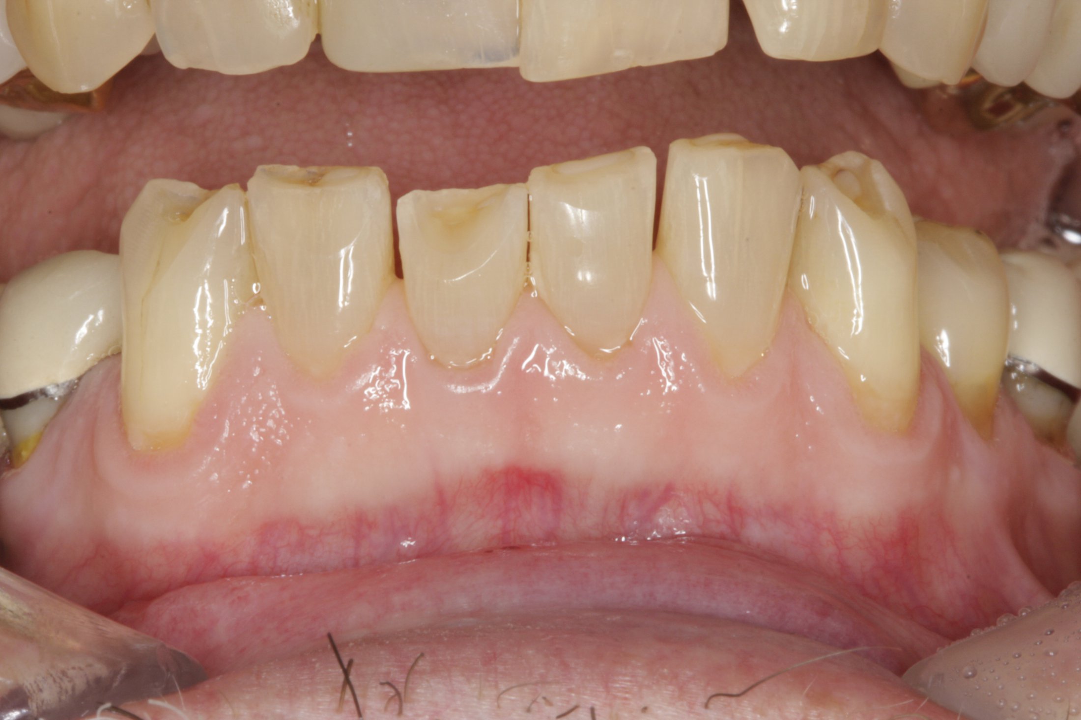 Dental Implants case study