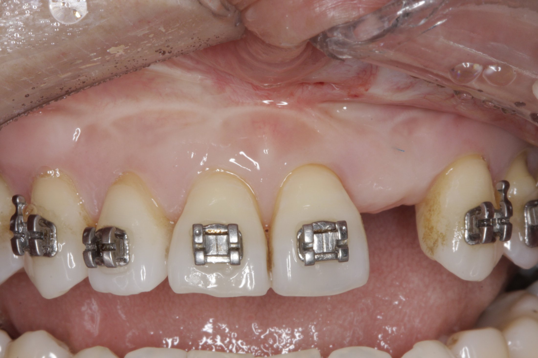 Dental Implants case study