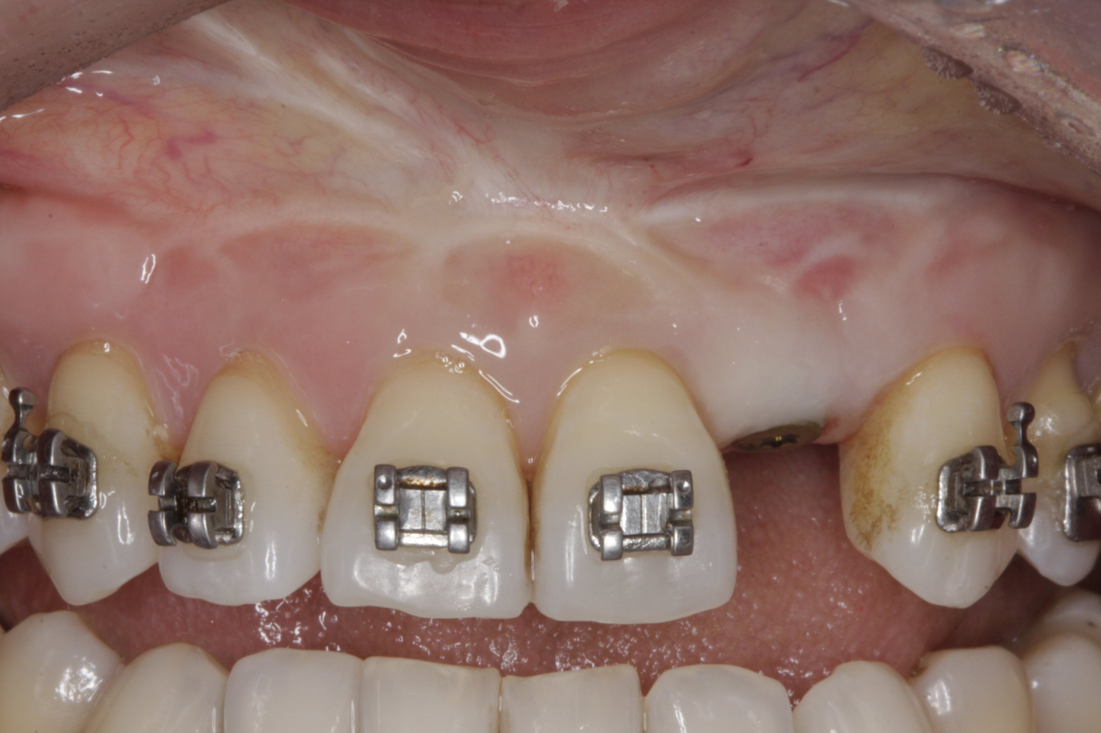 Dental Implants case study