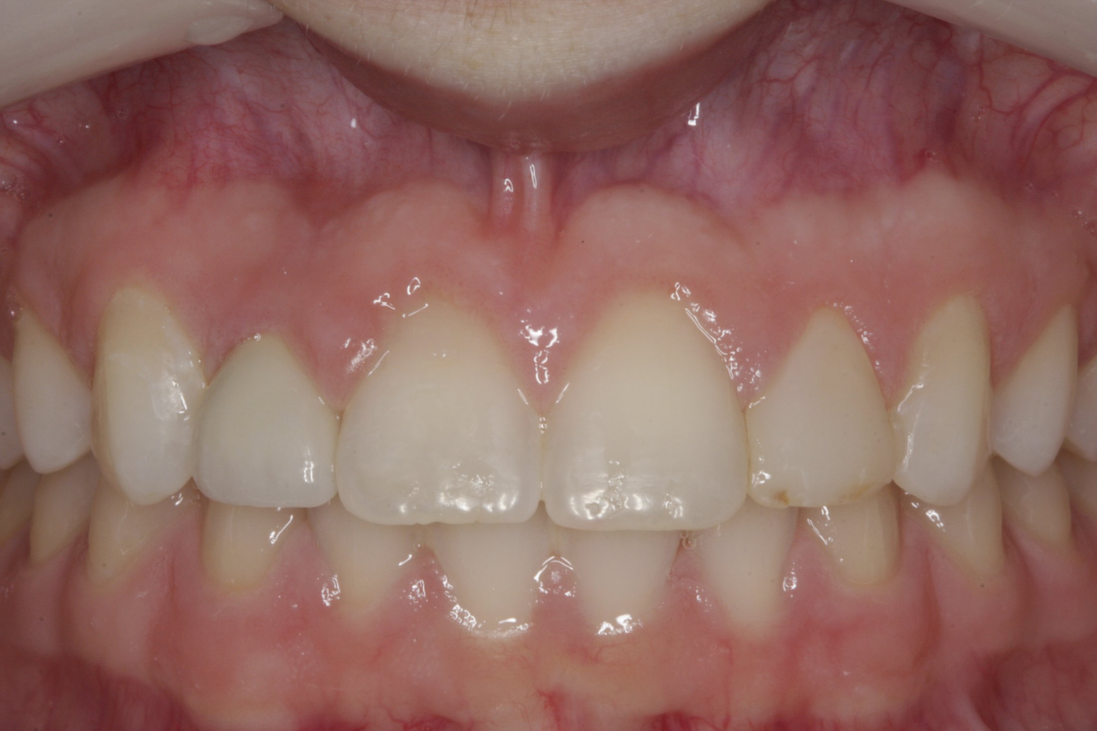 Dental Implants case study