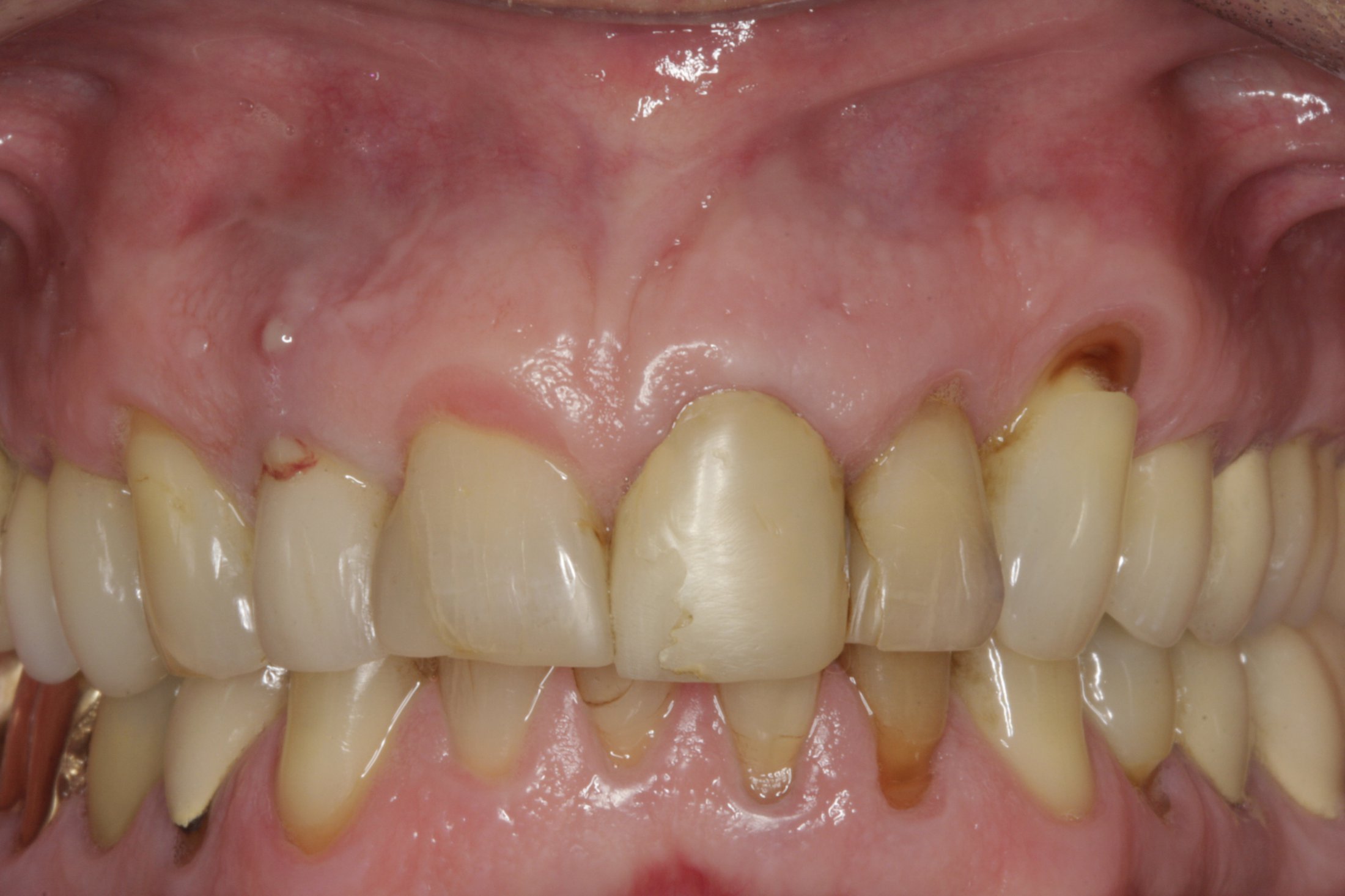 Dental Implants case study