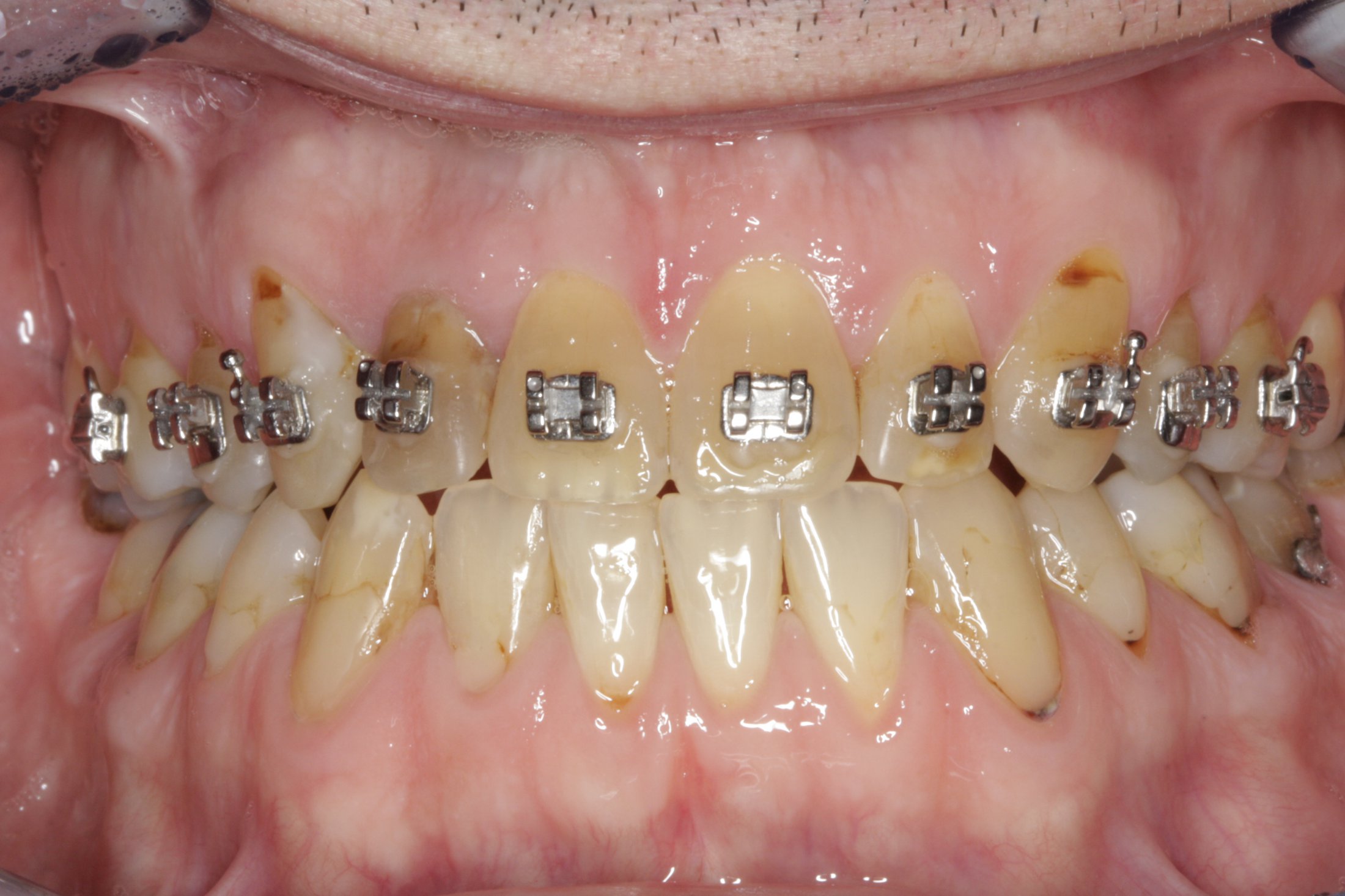 Dental Implants case study