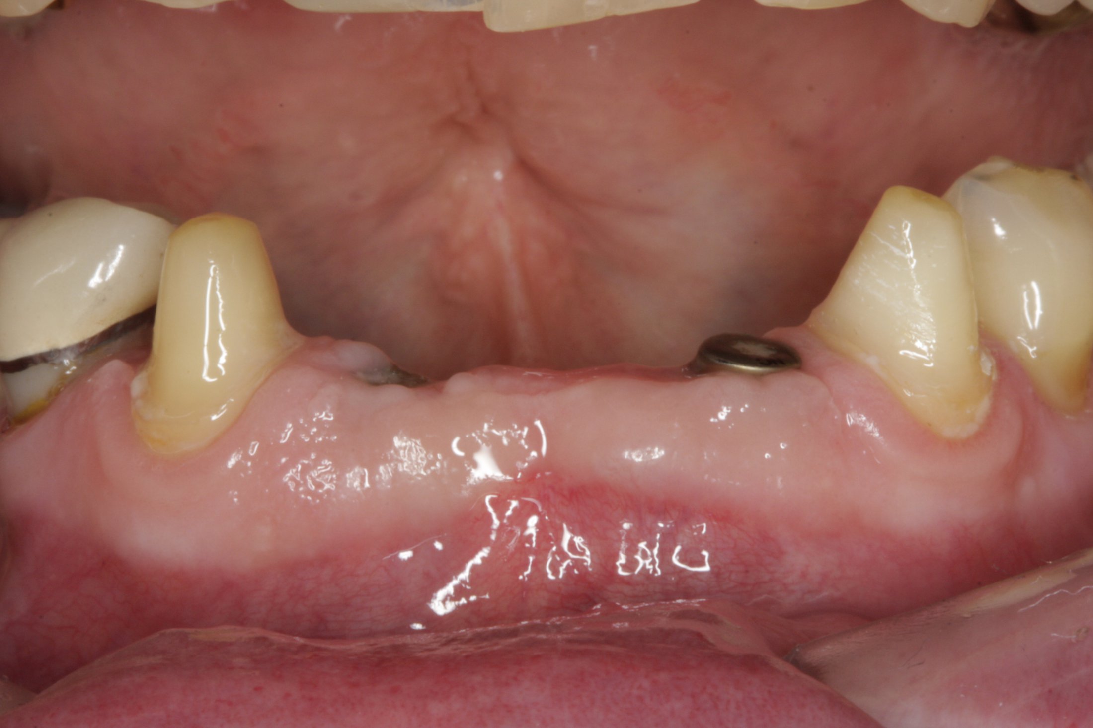 Dental Implants case study
