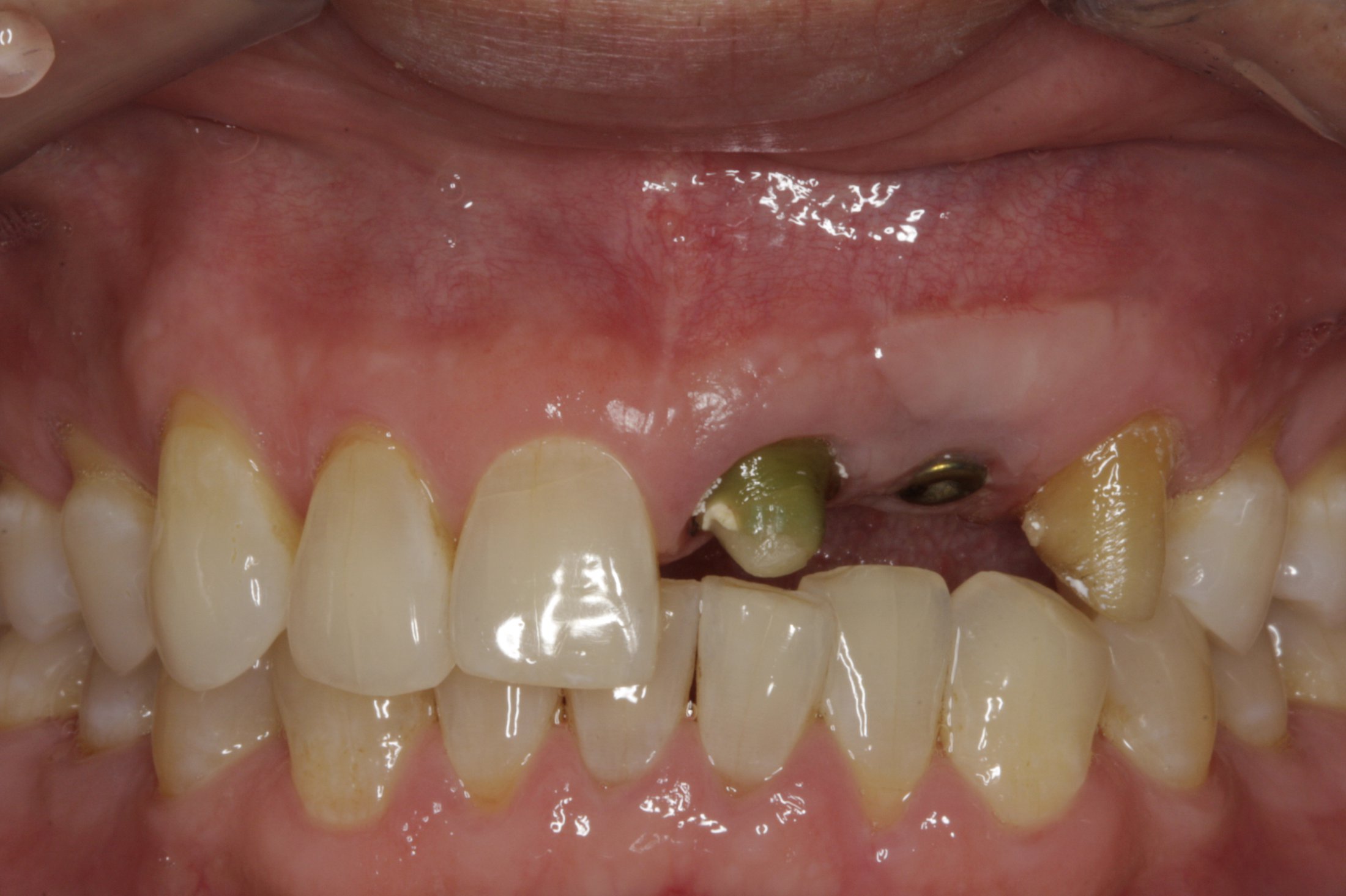 Dental Implants case study