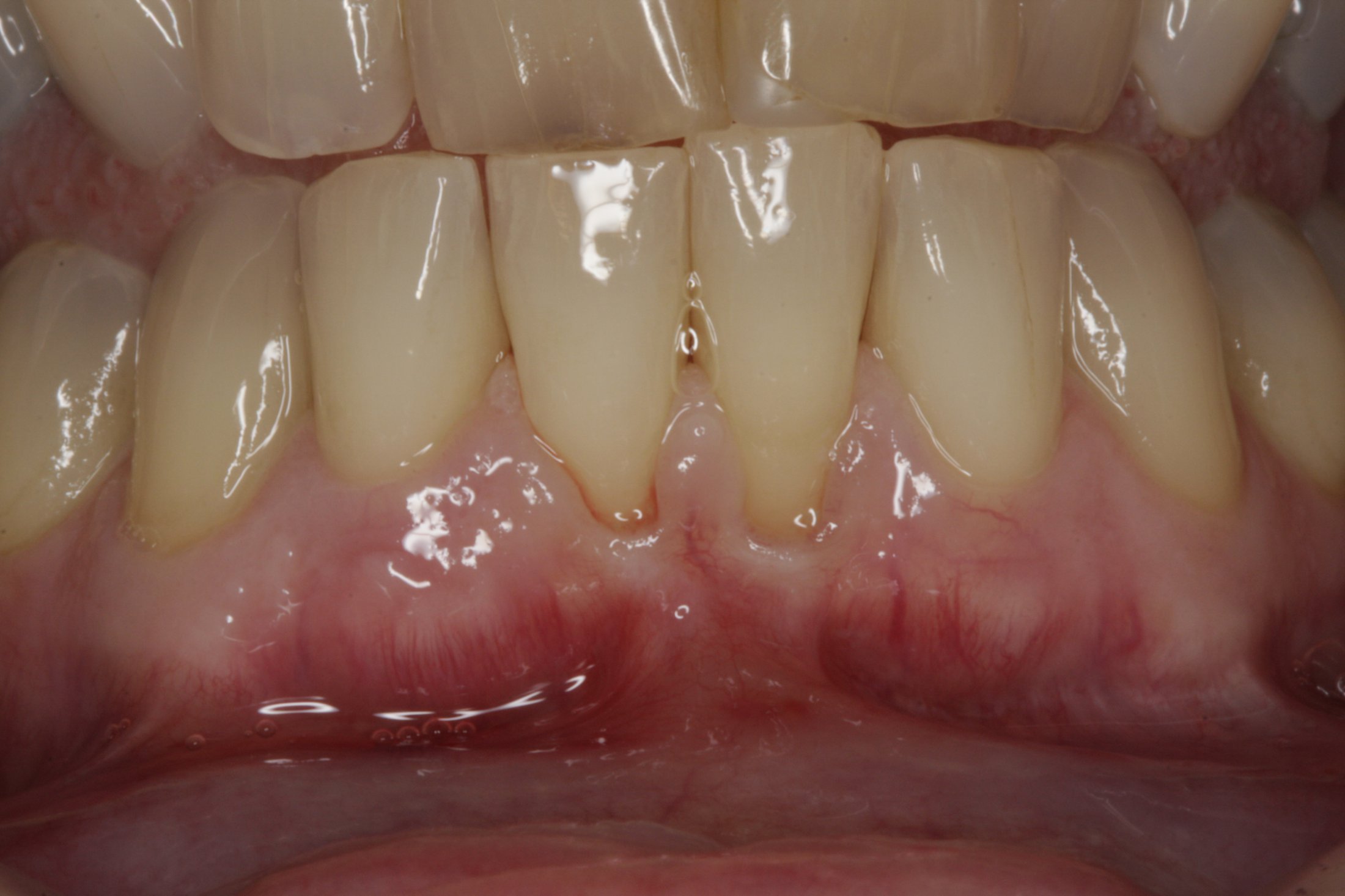 Connective Tissue Graft case study