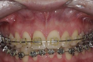 Dental Implants case study