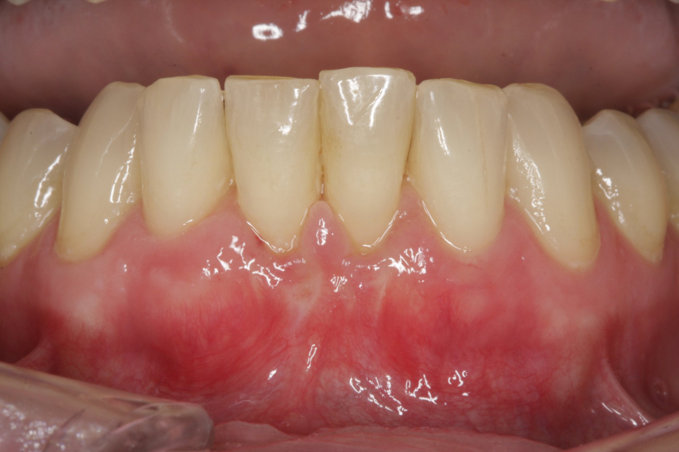 Connective Tissue Graft case study