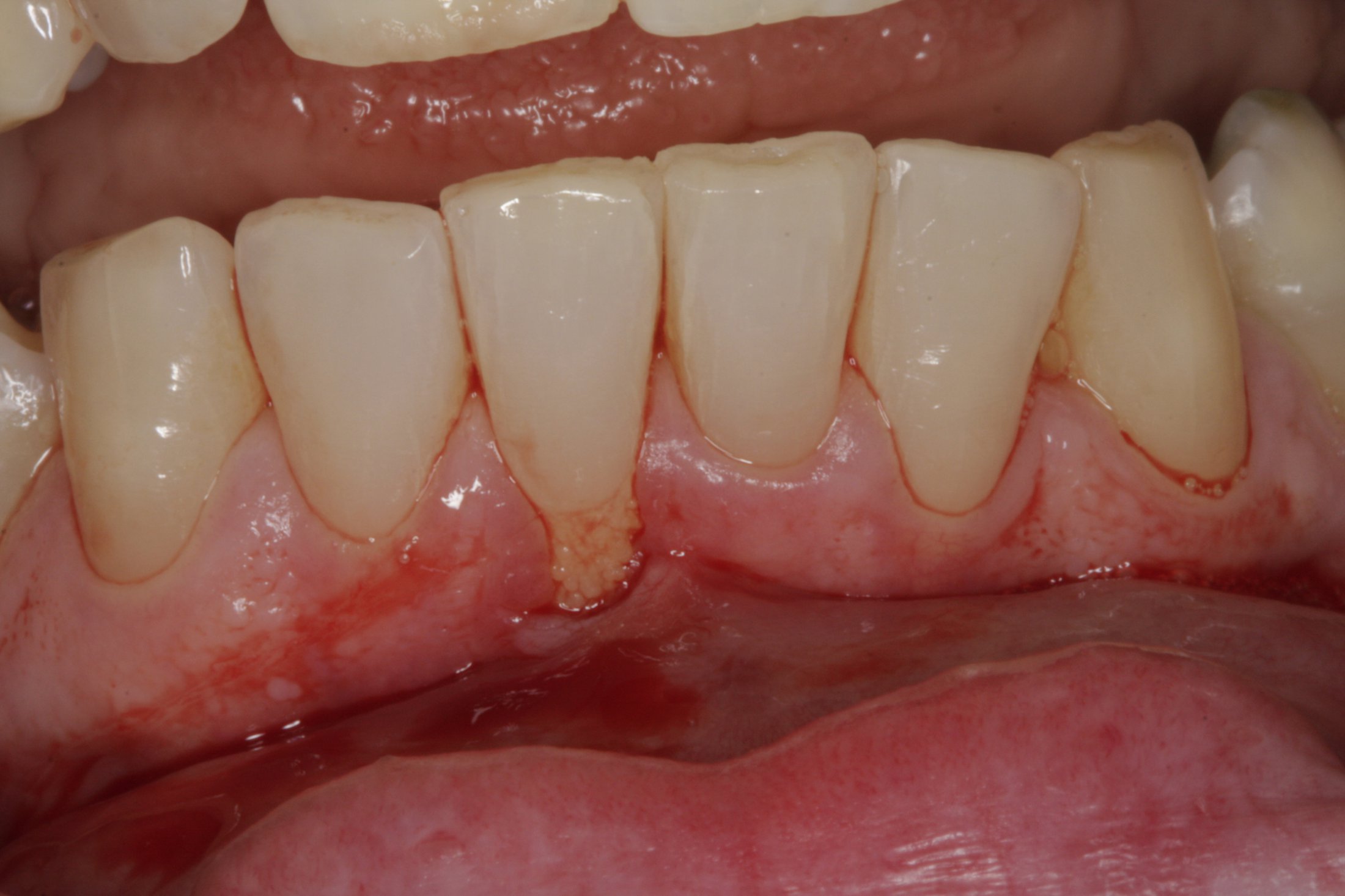 Connective Tissue Graft case study