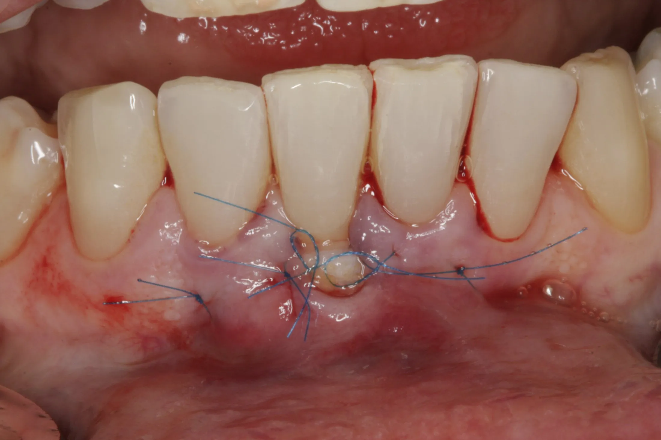 Connective Tissue Graft case study