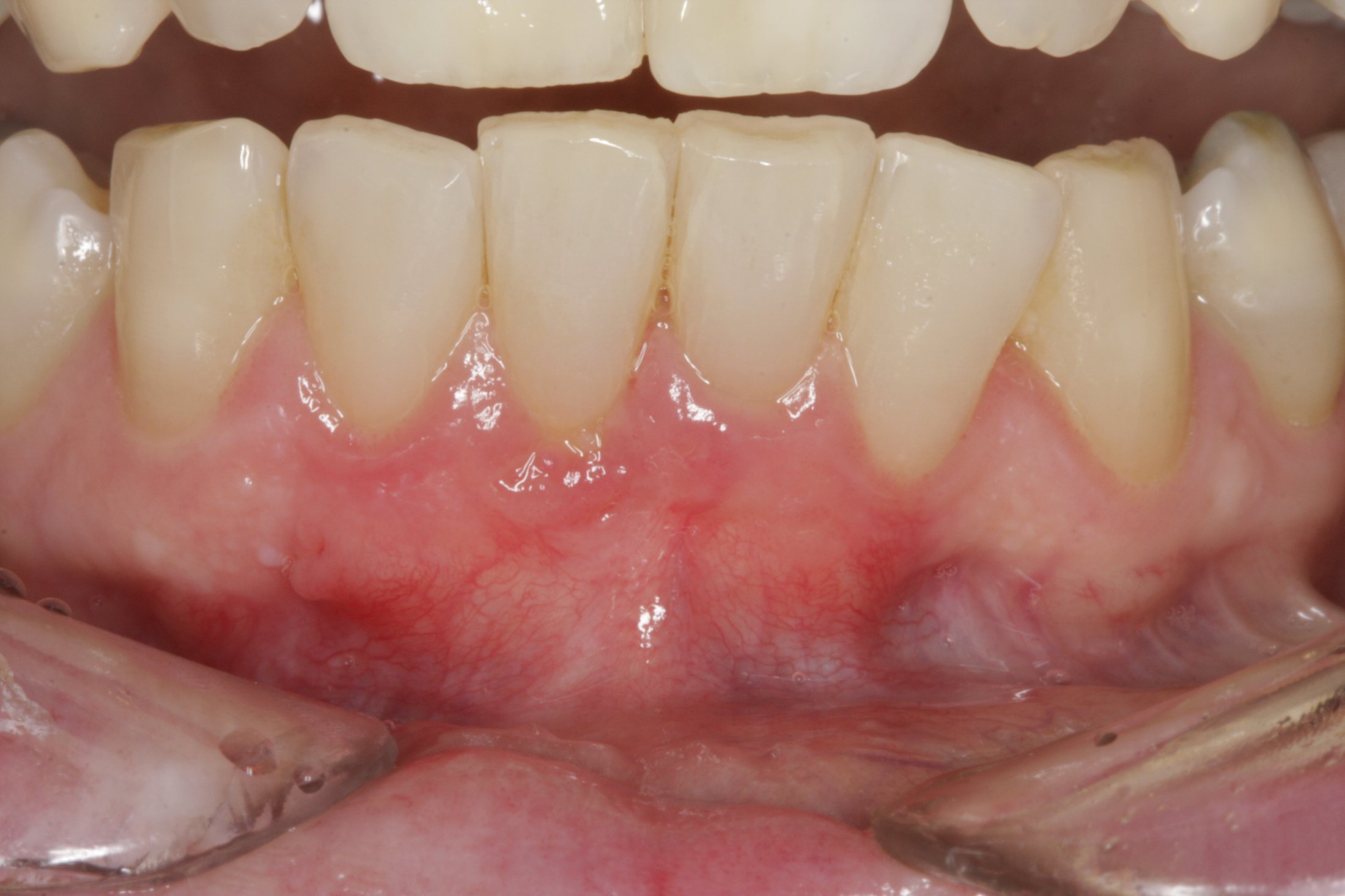 Connective Tissue Graft case study