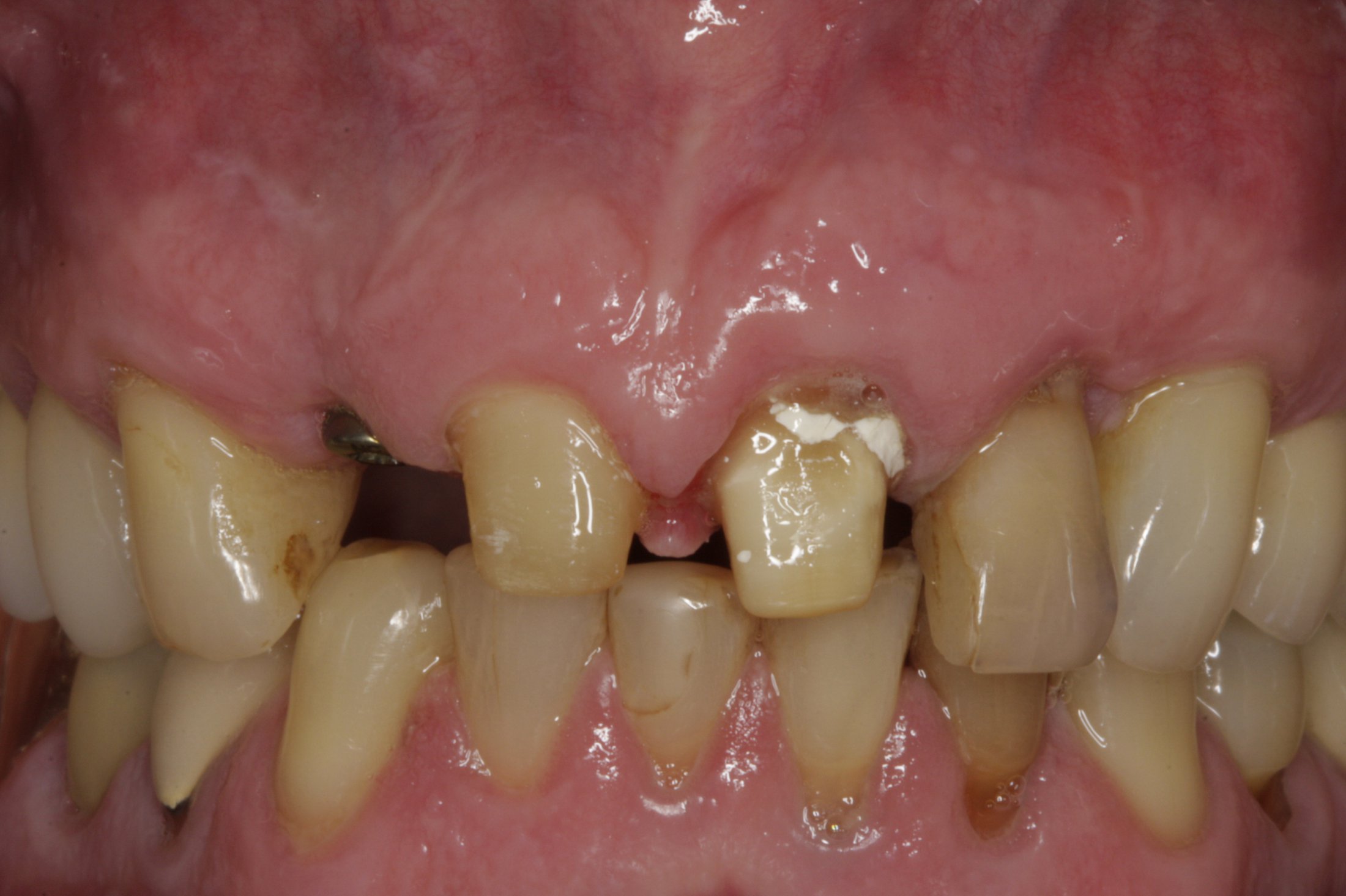 Dental Implants case study