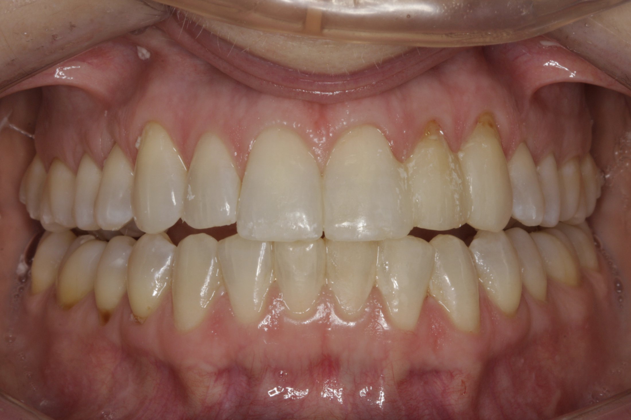 Dental Implants case study