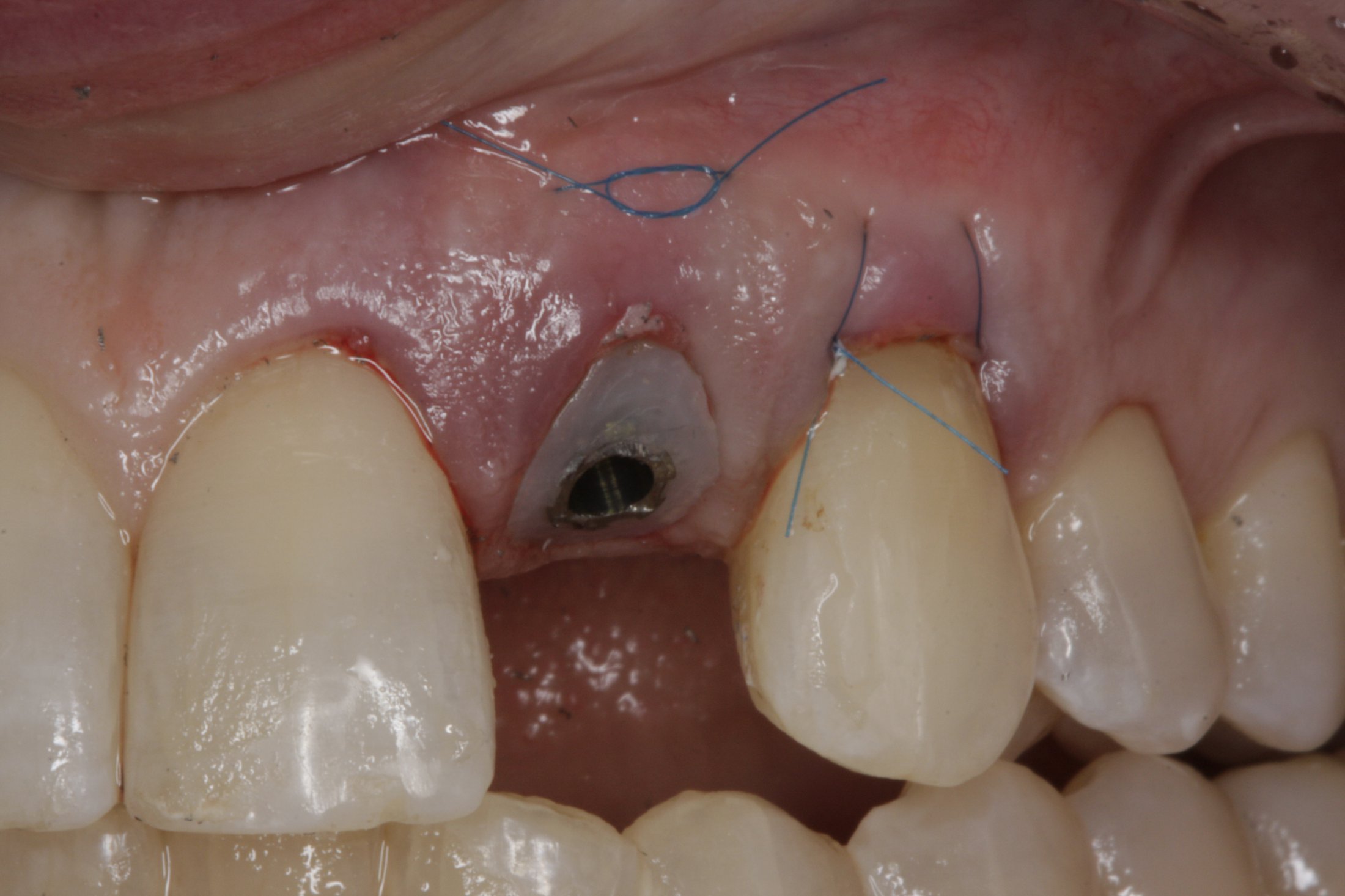 Dental Implants case study