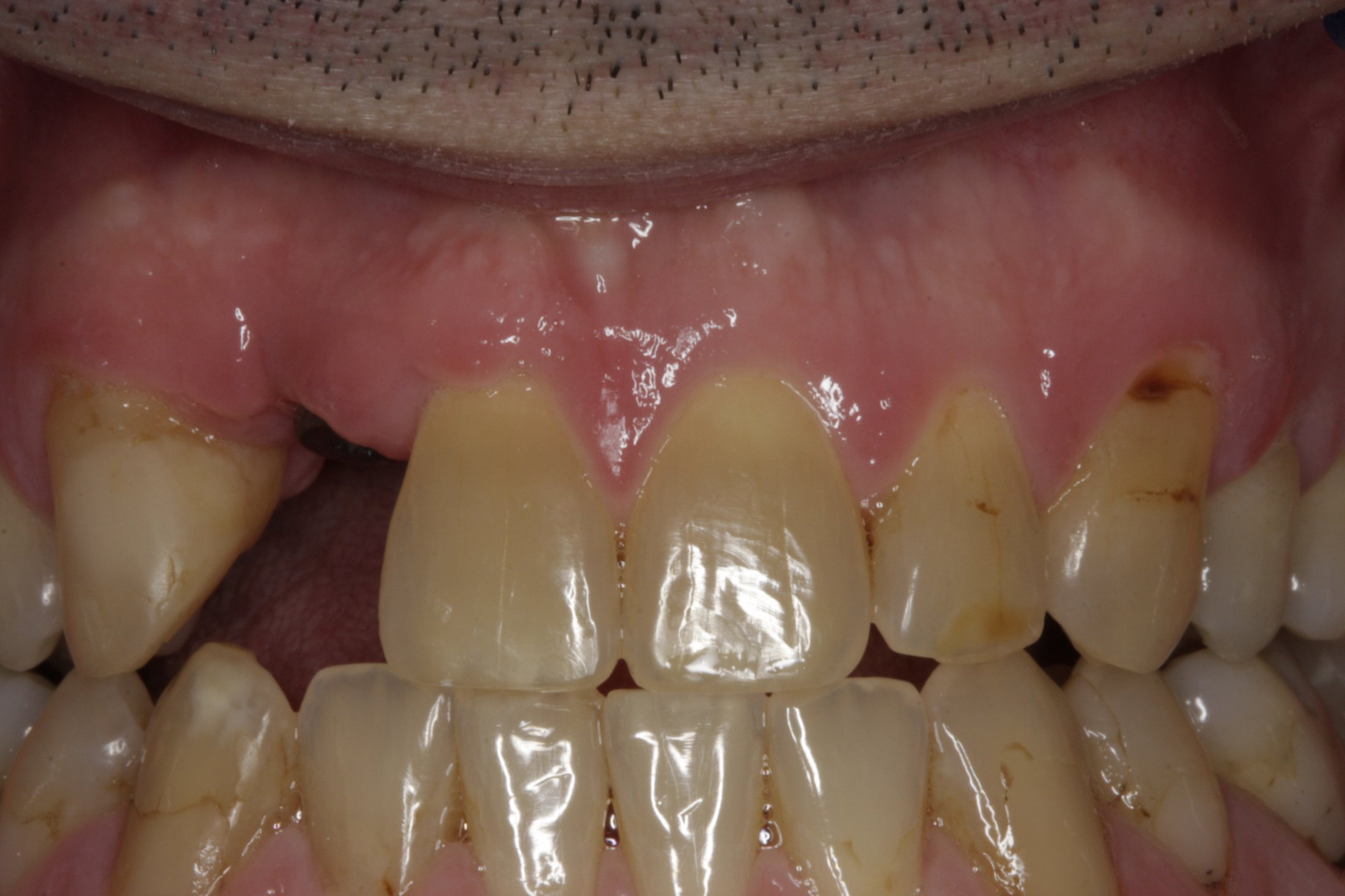 Dental Implants case study