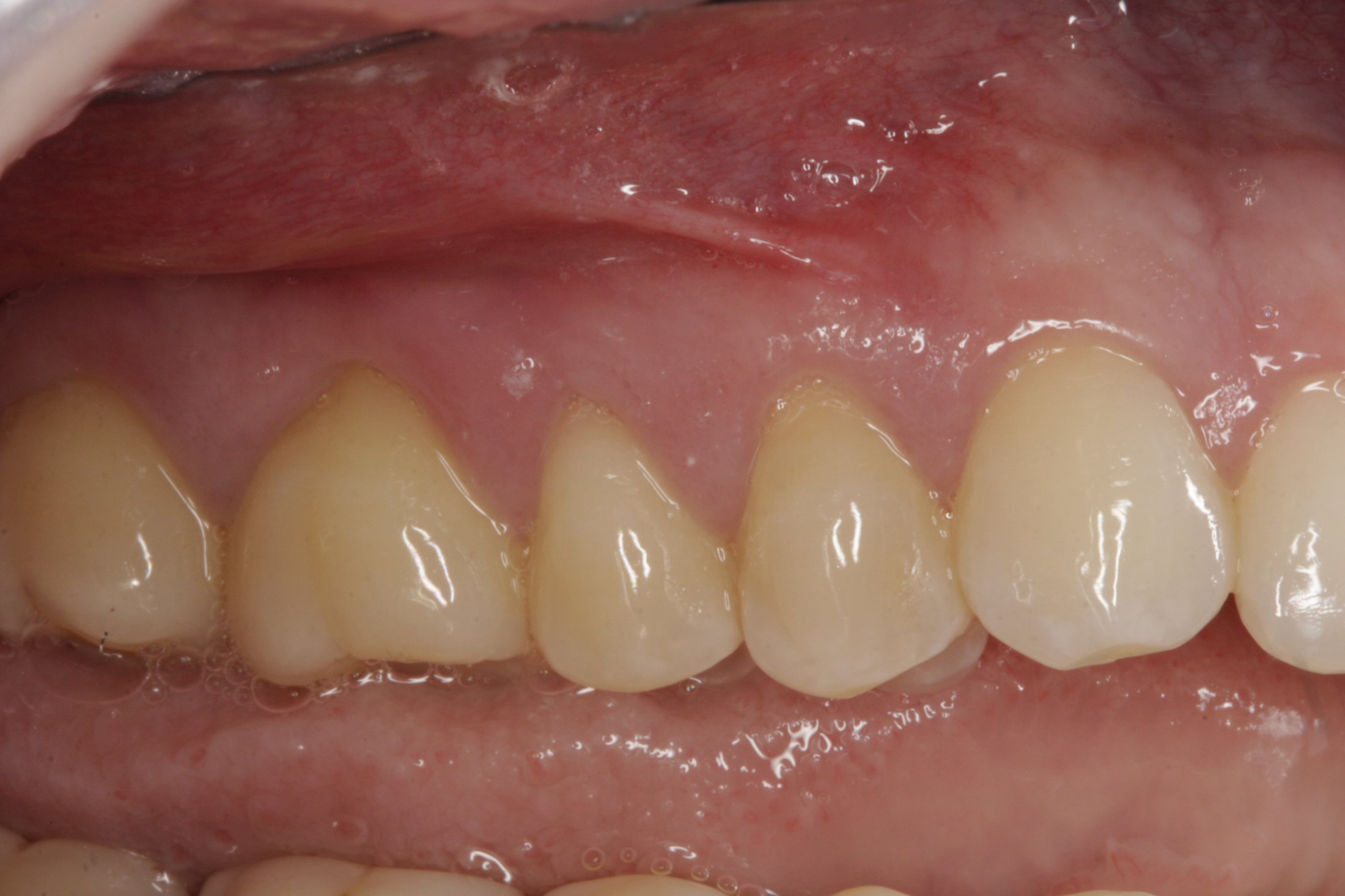 Allograft case study