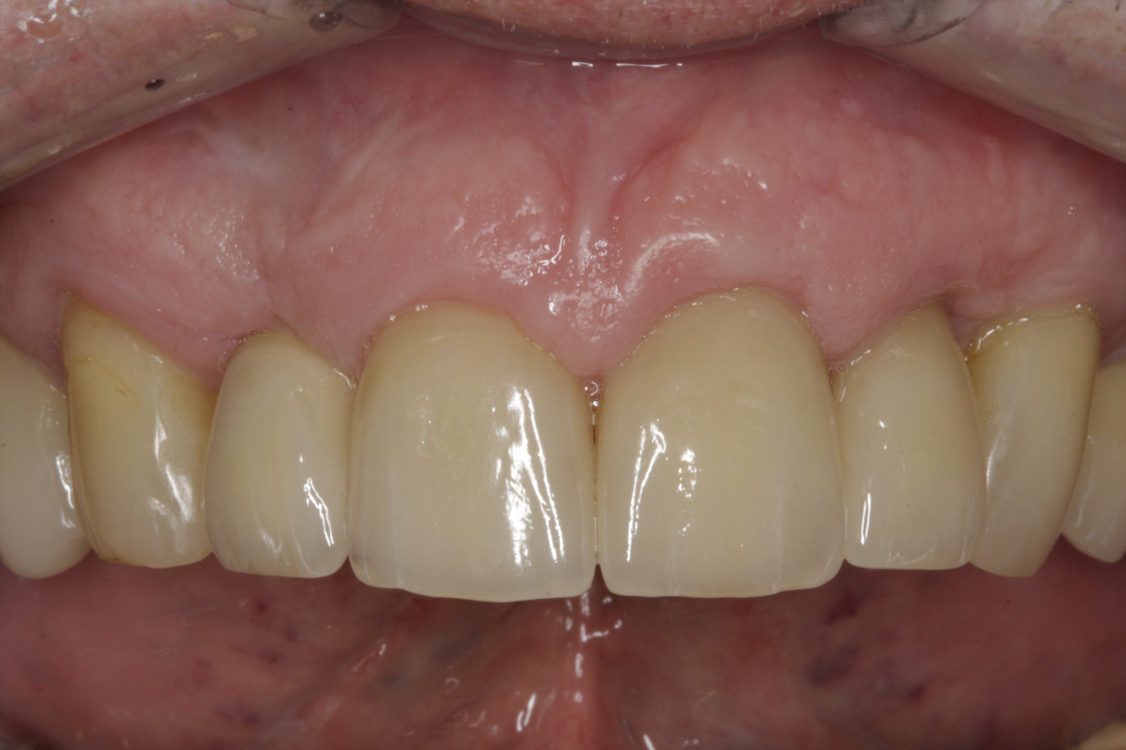 Dental Implants case study
