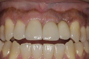 Dental Implants case study