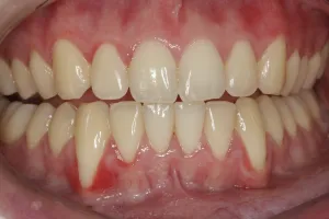 Connective Tissue Graft case study