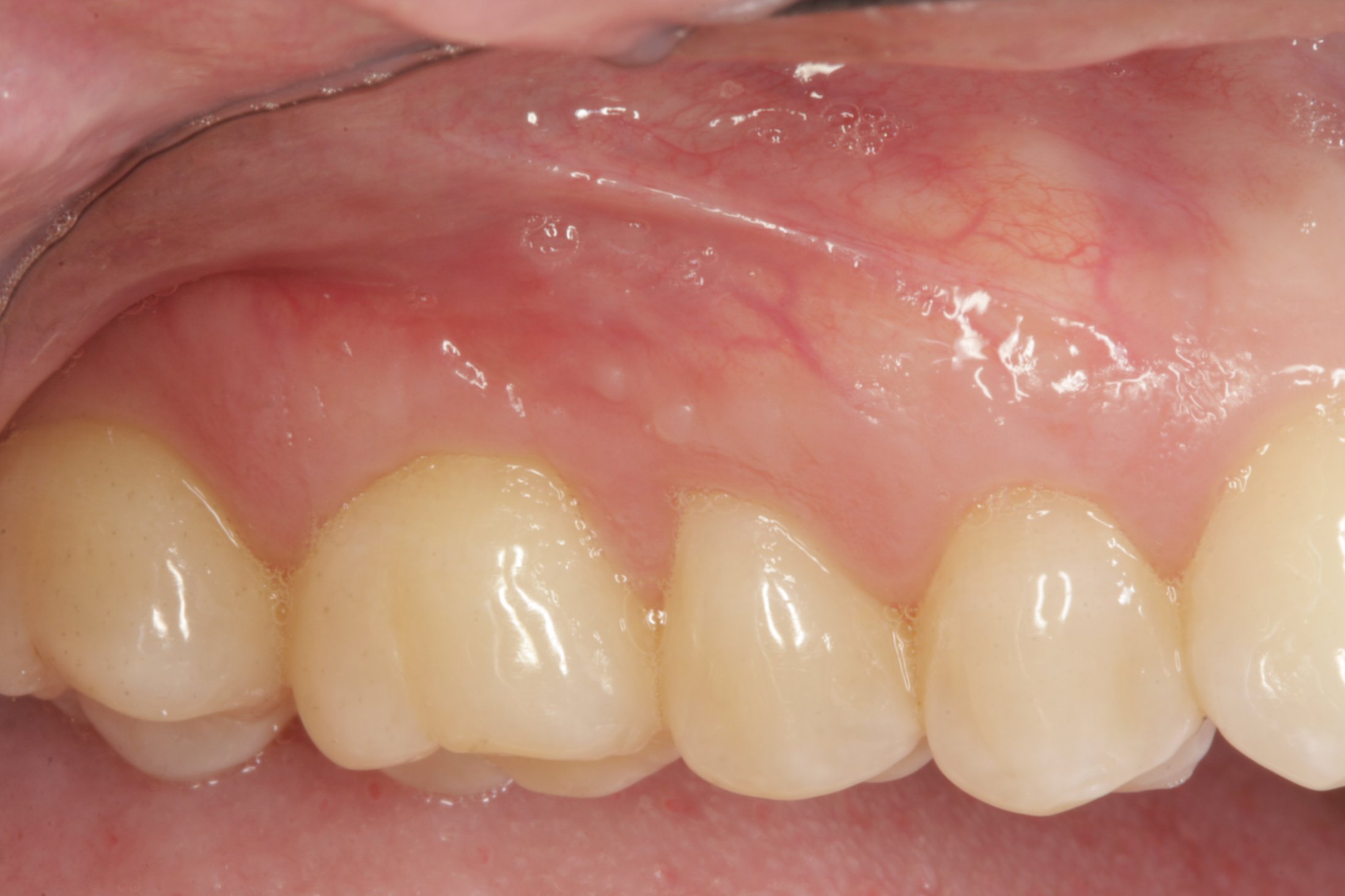 Allograft case study