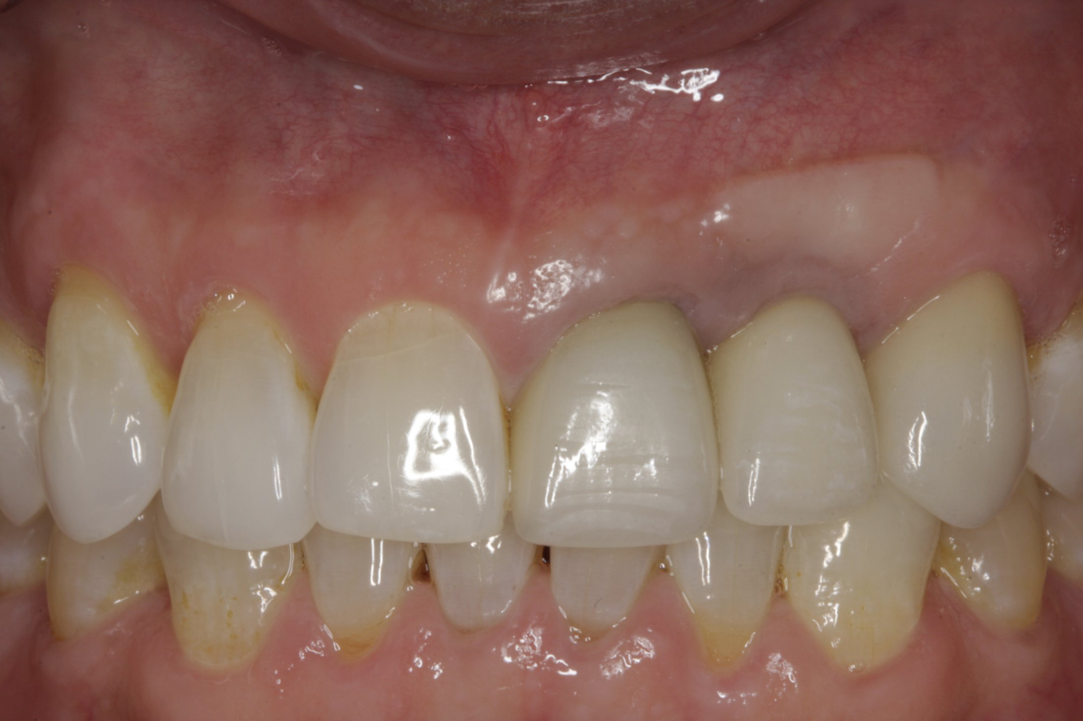 Dental Implants case study