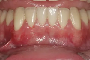 Connective Tissue Graft case study