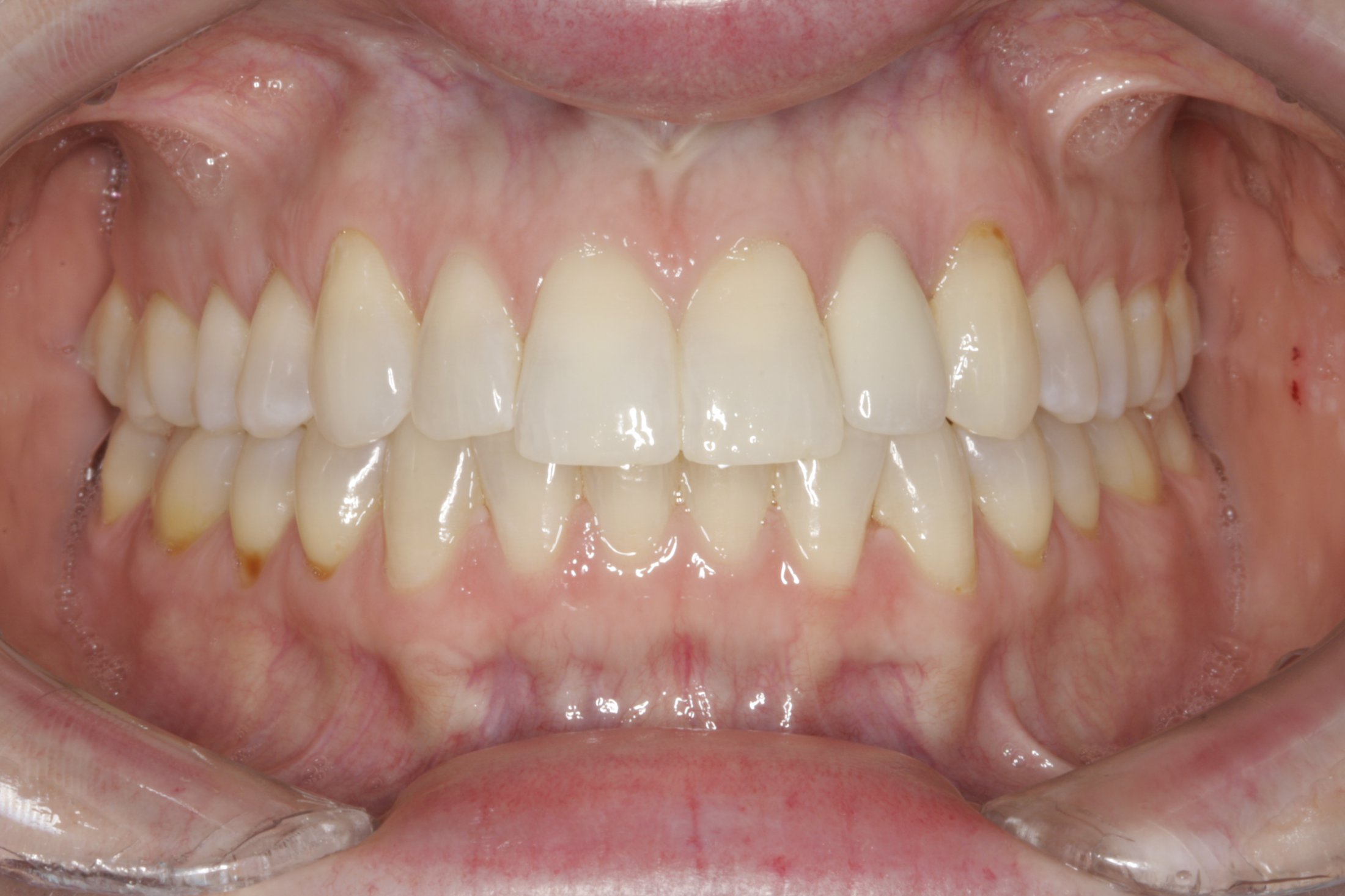 Dental Implants case study